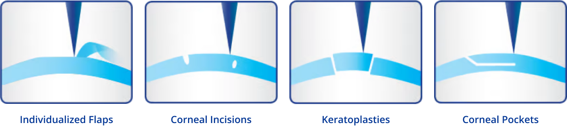 The WaveLight®FS200 Femtosecond Laser offers a large variety of personalized treatment options