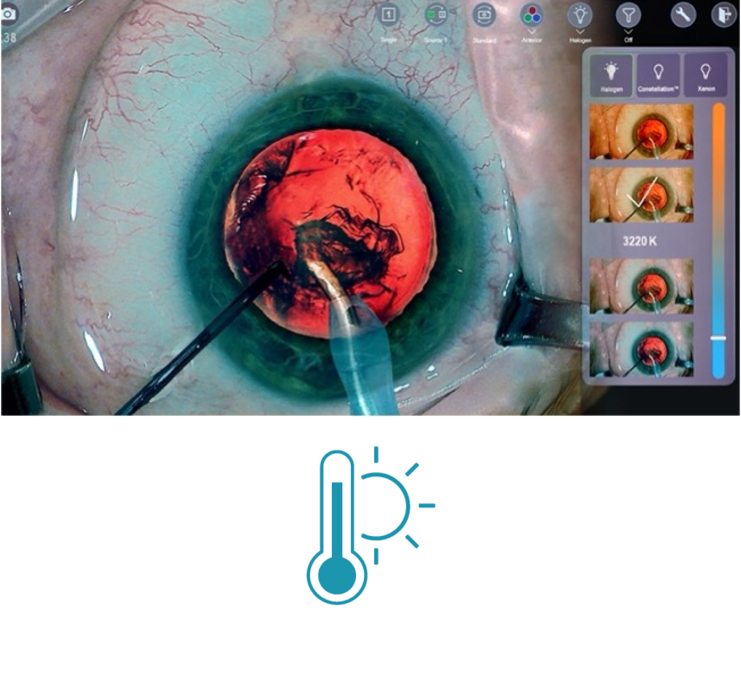 A closeup image of an eye during surgery with surgical tools on screen Thumbnails on the right side of the screen show the different light temperature filters available with NGENUITY 3D Visualization System.