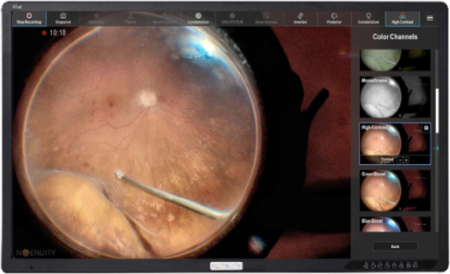 Close-up of the eye surgery