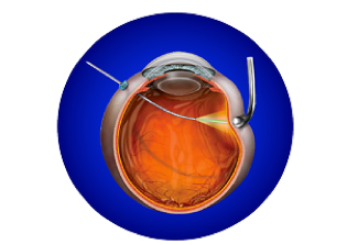Illustration of a VEKTOR Laser probe going through an eyeball