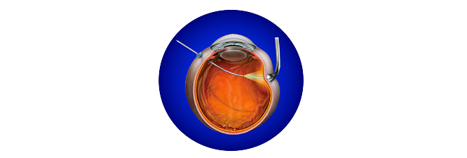 Illustration of a VEKTOR Laser probe going through an eyeball