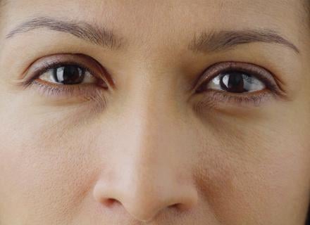 close-up of a woman with dry eye