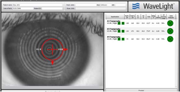 Wavelight Eye Scan