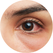 Closeup shot of red eye experiencing allergy symptoms