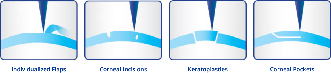 The WaveLight®FS200 Femtosecond Laser offers a large variety of personalized treatment options